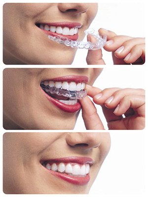 Invisalign-Trays